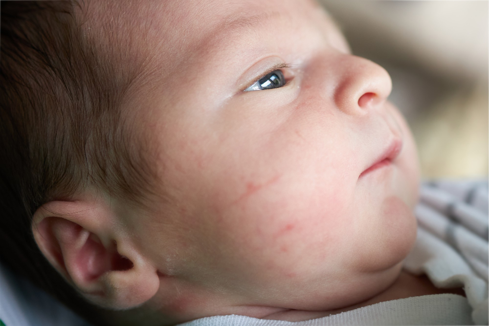 baby rash treatment