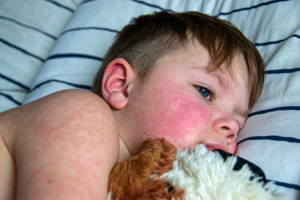 Managing baby allergies