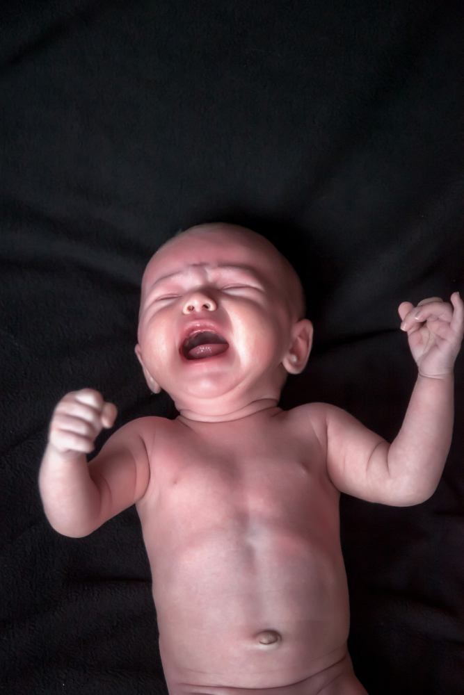 Understanding Newborn Jaundice Causes and Treatment Options